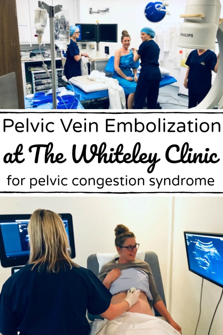 My Pelvic Vein Embolization at The Whiteley Clinic (for pelvic
